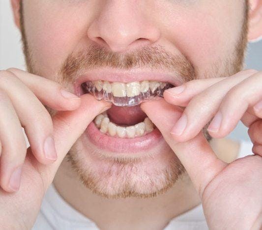 A man putting on his clear aligners.