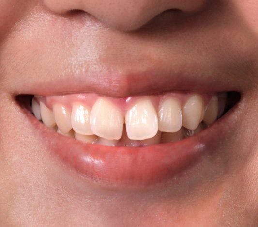 Cropped image of a woman with buck teeth.