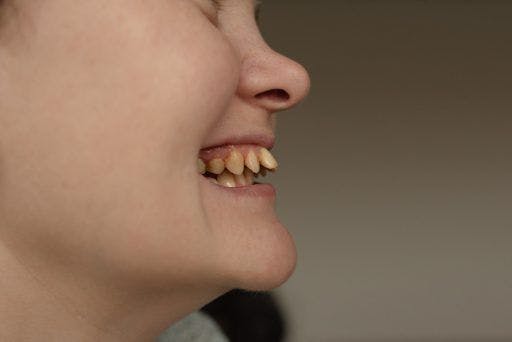 A woman with misaligned yellow teeth.