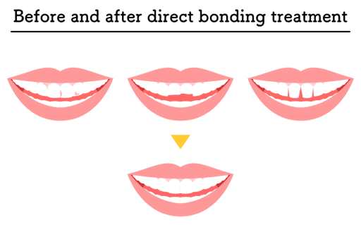 Illustration of smiles with decayed teeth, chipped teeth, and tooth gaps then showing a perfect smile after direct bonding treatment.