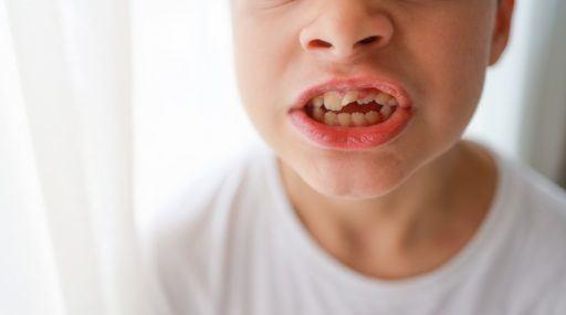 Closeup of child’s face with crooked teeth and an open bite.